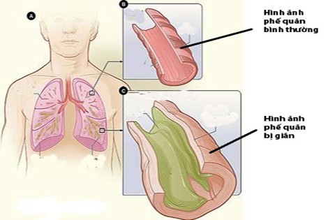 Giãn phế quản là tình trạng các phế quản của phổi bị giãn ra khó hồi phục, đặc biệt là các phế quản trung bình.