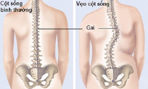 Nguyên nhân và hậu quả chứng cong vẹo cột sống