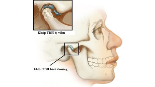 Viêm khớp thái dương hàm hay còn được gọi là chứng rối loạn khớp thái dương hàm.