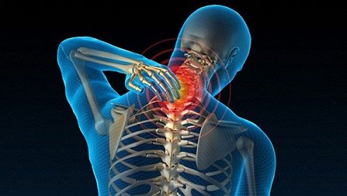 Viêm Cơ Vai Gáy là gì? Nguyên nhân, cách phòng ngừa và điều trị bệnh 2 Thoái hóa đốt sống cổ là một trong những nguyên nhân gây viêm cơ vai gáy