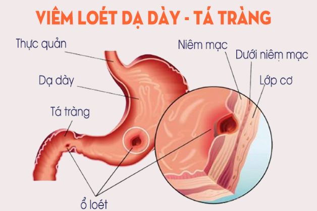 Đầy bụng dù không ăn nhiều là vì sao
