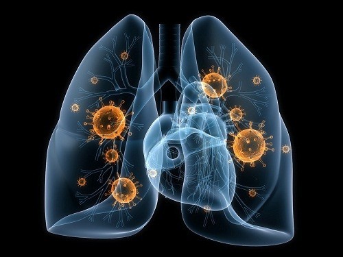 Viêm phổi, tình trạng phổi bị nhiễm trùng, có thể là nguyên nhân gây đau khi thở.