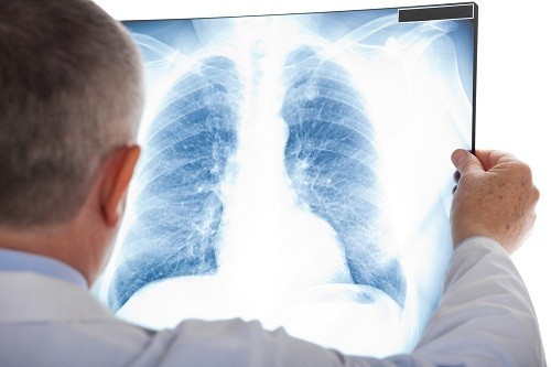 Nguyên nhân gây đau khi hít thở cũng có thể xuất hiện nếu ung thư liên quan đến màng phổi.