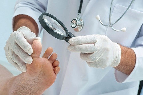 Bệnh động mạch ngoại biên thường gây ra hệ quả gì ở ngón chân cái