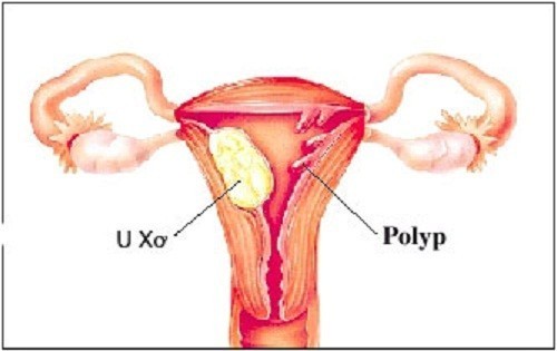 Polyp buồng tử cung cần được chữa trị kịp thời hiệu quả