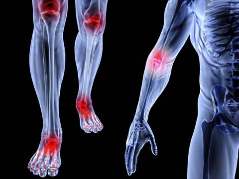 Rối loạn cơ xương khớp gây ảnh hưởng tới đời sống sinh hoạt