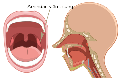 Triệu chứng sưng amidan là biểu hiện của viêm amidan