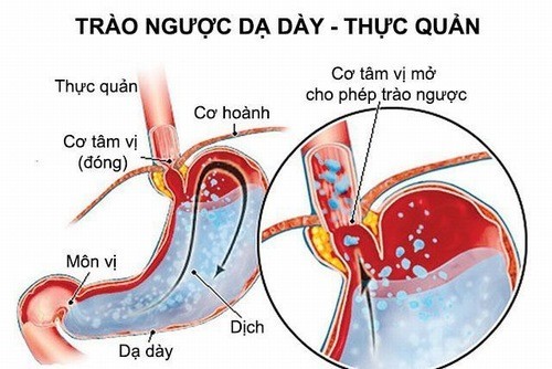 6 nguyên nhân gây trào ngược dạ dày thực quản