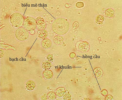 Lượng bạch cầu cao trong nước tiểu chứng tỏ bạn có nguy cơ viêm nhiễm đường tiết niệu