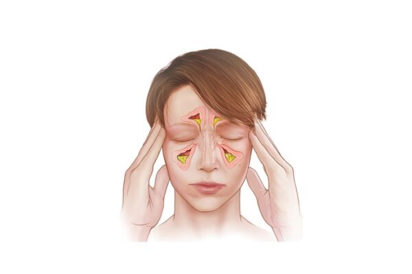 Viêm xoang là tình trạng niêm mạc mũi xoang bị nhiễm khuẩn 