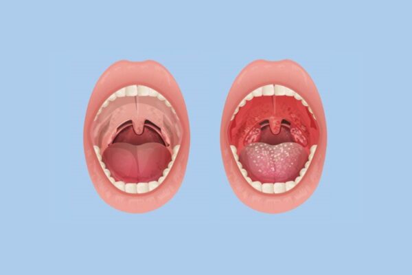 Viêm amidan là bệnh vùng họng nguy hiểm, ảnh hưởng lớn tới sức khỏe