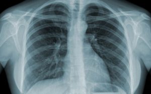 Chụp Xquang phổi là phương pháp để xác định nhiều bệnh lý ở phổi
