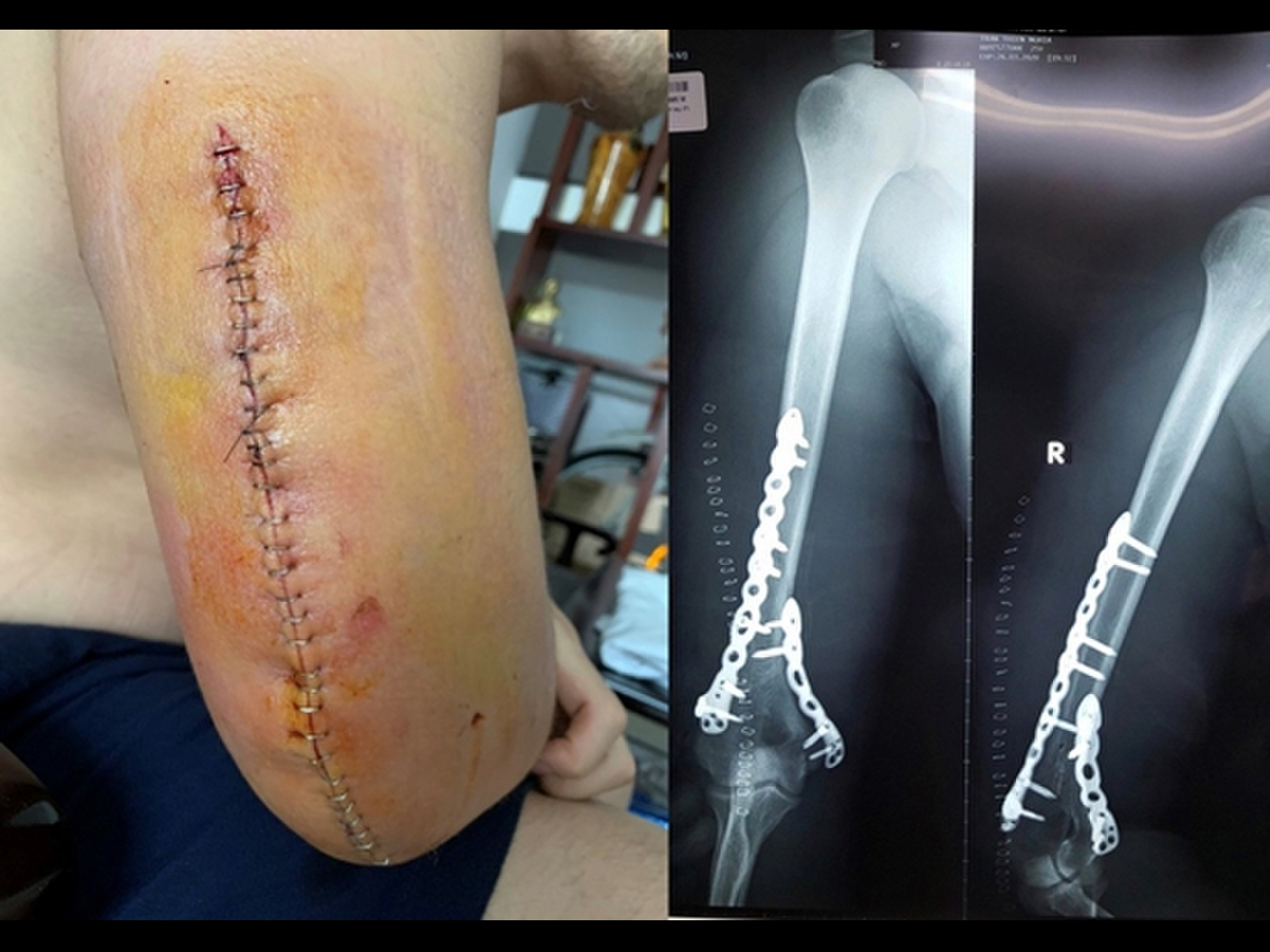 Kết hợp xương bằng nẹp v&iacute;t mang lại hiệu quả cao