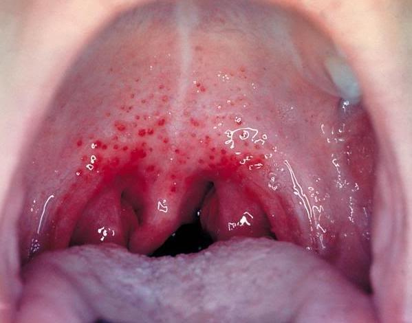 Viêm họng hạt bao gồm 2 dạng: viêm họng cấp tính và mạn tính