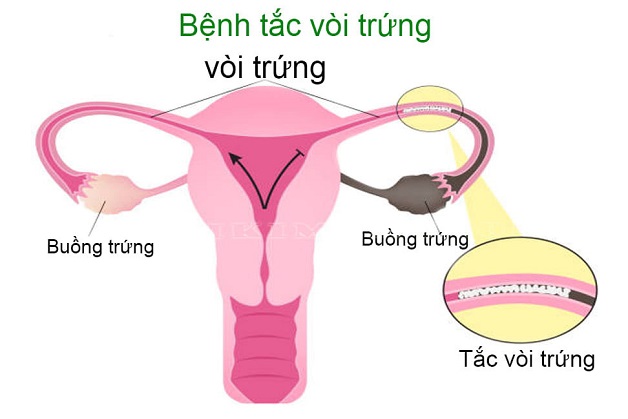 Khi mắc bệnh, vòi trứng có hình dạng như sợi dây cước bị rối