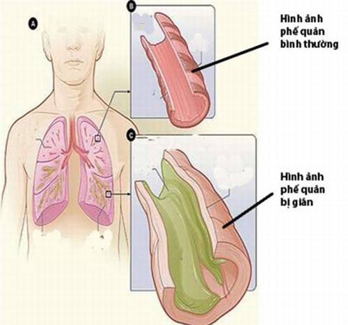 Giãn phế quản là tình trạng biến dạng phế quản thường xuyên không hồi phục xảy ra ở các phế quản có kích thước trung bình kèm theo thành phế quản bị phá hủy. 