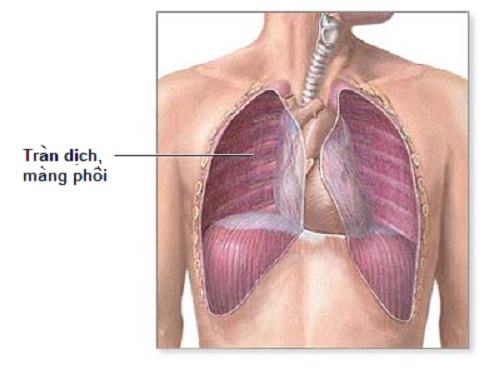 Tràn dịch màng phổi là tình trạng tích tụ dịch trong khoang chống giữa phổi và thành ngực