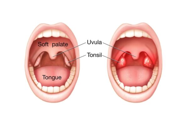 Viêm amidan là bệnh lý có thể xảy ra ở bất kỳ đối tượng nào