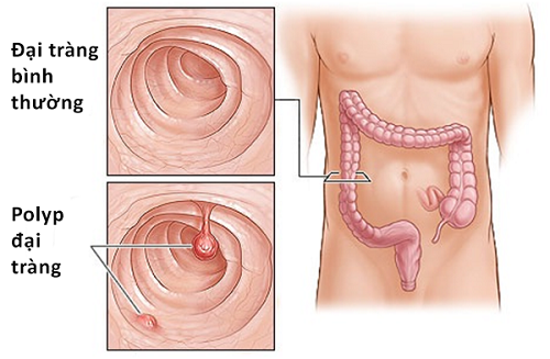 Cắt polyp đại tràng là phương pháp điều trị hiệu quả