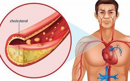 Cholesterol cao là nguyên nhân gây nên các bệnh lý tim mạch