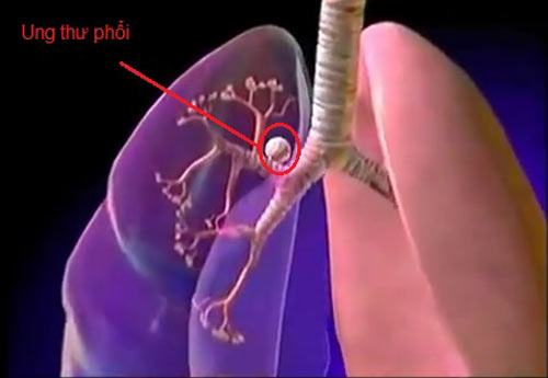 Mỗi năm số người tử vong vì ung thư phổi nhiều hơn ung thư vú