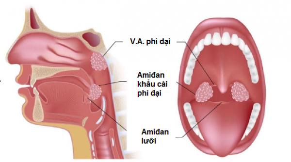 4. Phân Độ Phì Đại VA