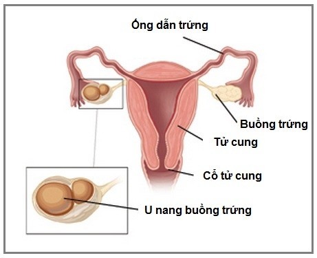 U nang buồng trứng có thể ảnh hưởng đến khả năng mang thai cần được phát hiện sớm và điều trị đúng cách