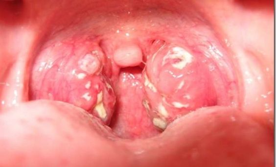 Viêm họng là tình trạng viêm họng kéo dài, thành họng xuất hiện những hạt nhỏ li ti như đầu ghim