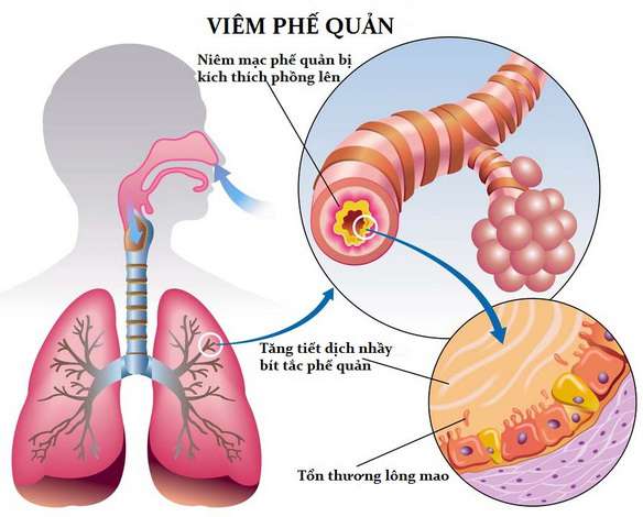 6 bệnh viêm phổi và viêm phế quản thường gặp ở trẻ