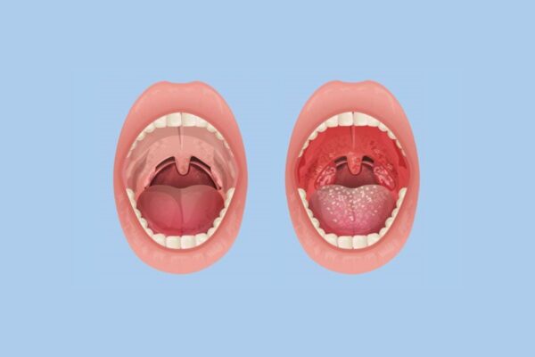 Viêm họng hạt, viêm họng teo... là các dạng viêm họng mạn tính thường gặp