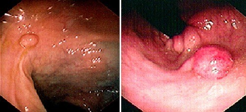 hinh-anh-benh-polyp-dai-truc-trang-2