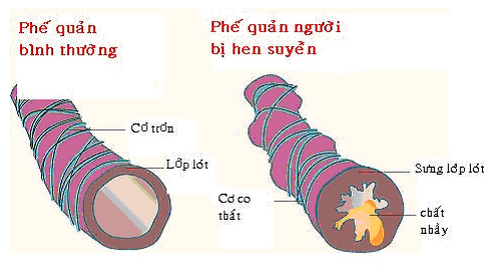 Hen suyễn là tình trạng viêm mạn tính đường thở, hậu quả của quá trình tương tác giữa cơ địa dị ứng với các yếu tố gây bệnh hen suyễn từ ngoài môi trường. 