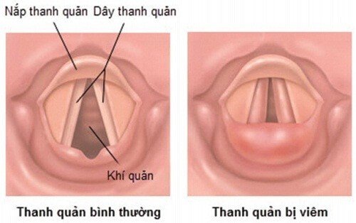 Bệnh viêm thanh quản là tình trạng dây thanh trong họng bị viêm và bị kích thích khiến bị sưng lên