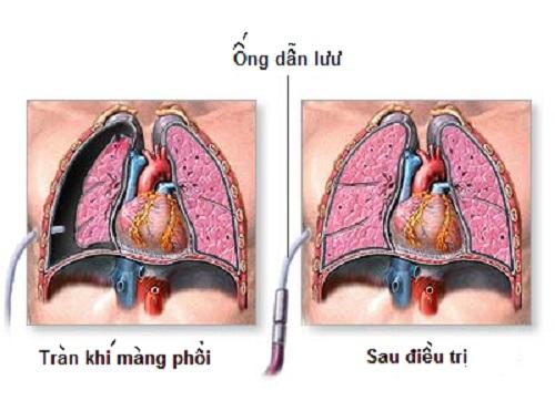 Tràn khí màng phổi là một biến chứng nghiêm trọng của bệnh viêm phổi