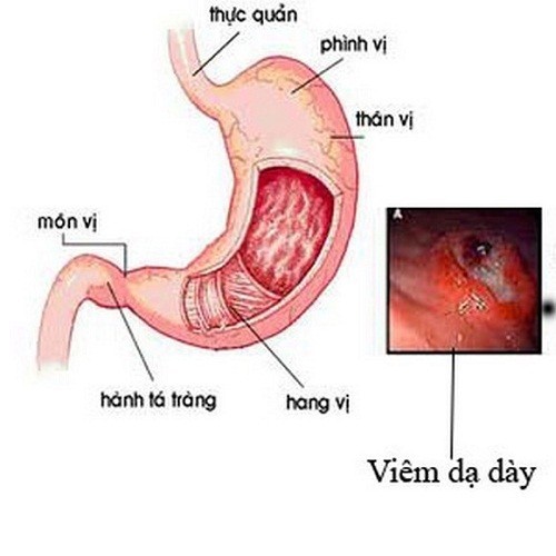 Giải pháp điều trị bệnh về dạ dày từ viên tinh nghệ chè dây Giải pháp điều trị bệnh về dạ dày từ viên tinh nghệ chè dây