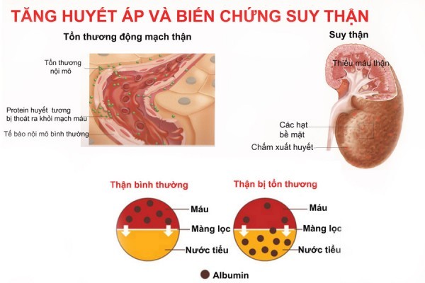 Tăng huyết áp – nguyên nhân gây suy thận