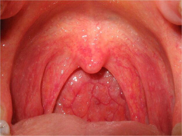 Bệnh lý viêm thanh quản được xác định là tồn tại khi thanh quản viêm, sưng, phù nề.