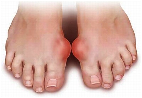 Bệnh gout cần được phát hiện sớm và điều trị hiệu quả