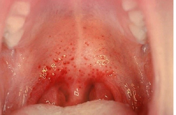 Người bị viêm họng hạt thường bị ho khan, ho không có đờm và thường kéo dài không khỏ