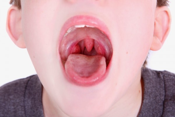 Khi virus, vi khuẩn tấn công mũi họng có thể khiến amidan bị sưng viêm, hay còn gọi là viêm amidan.