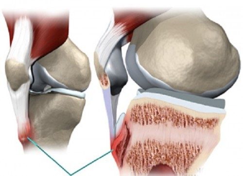Dấu Hiệu Nhận Biết Viêm Gân Cổ tay, đầu gối và gót chân 2 Khi người bệnh thực hiện các hoạt động quá mức như liên tục chạy nhảy có thể dẫn đến viêm gân bánh chè gây đau và hạn chế vận động.