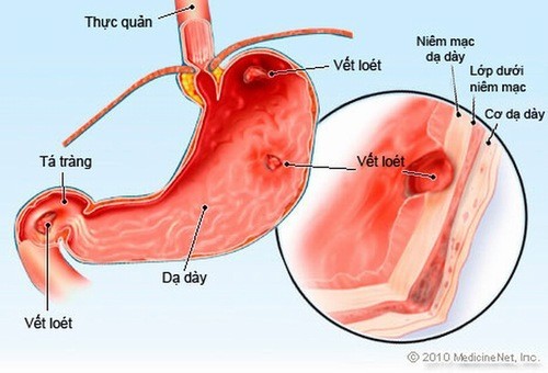 Tổng Quan về Polyp Tá Tràng