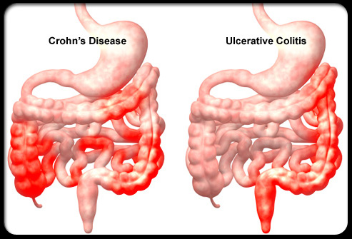 Bệnh Crohn đại tràng là bệnh lý đường ruột mạn tính.