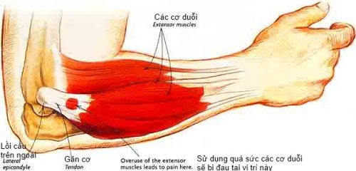 Bệnh Viêm Đa Cơ: Nguyên nhân, triệu chứng, chẩn đoán và cách điều trị 1 Bệnh Viêm Đa Cơ: Nguyên nhân, triệu chứng, chẩn đoán và cách điều trị 1
