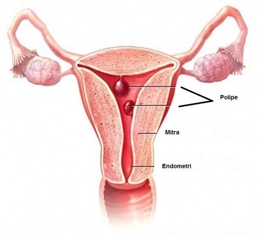 Khi nào nên mổ polyp lòng tử cung?