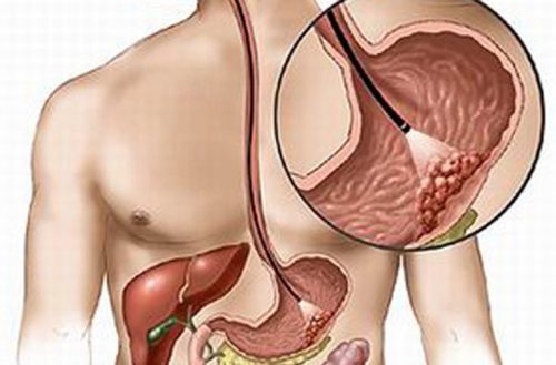 Cách phòng và chữa bệnh rối loạn tiêu hóa đang là một trong các vấn đề khiến cộng đồng quan tâm nhiều nhất khi bảo vệ sức khỏe.