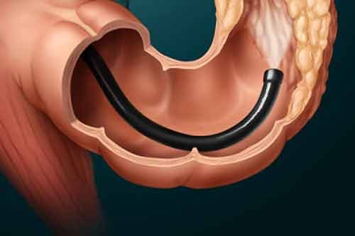 Các bệnh nhân bị viêm loét dạ dày hiện nay thường chọn làm nội soi gây mê