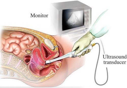 Siêu âm đầu dò được chỉ định trong chẩn đoán thai giai đoạn đầu