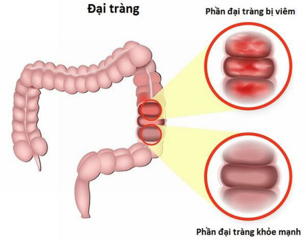 Đại tràng là bộ phận ruột già của cơ thể, là bộ phận cuối cùng của hệ thống tiêu hóa có chiều dài khoảng 1,2m sắp xếp gọn gàng trong cơ thể.