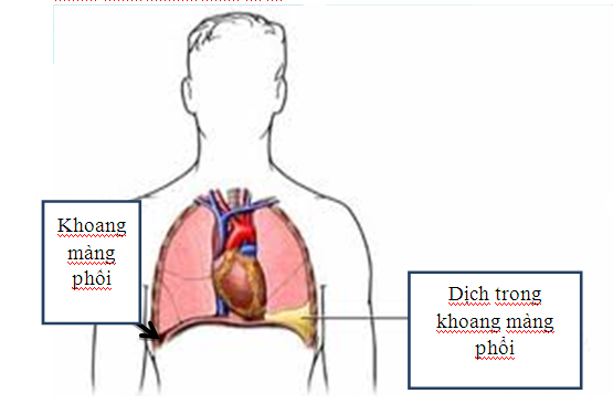 Tràn dịch màng phổi là bệnh lý nguy hiểm cần phát hiện sớm và điều trị hiệu quả